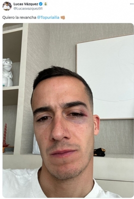 Sau khi bị đối thủ thúc cùi chỏ vào mặt, Vazquez đã đăng một bức ảnh chụp đôi mắt xanh của mình lên mạng xã hội và tweet nhà vô địch UFC Topria