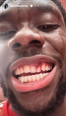 Bild đưa tin hai chiếc răng cửa của Davis đã bị gãy trong cuộc đối đầu và cầu thủ này đã phản ứng bằng cách đăng ảnh lên Instagram